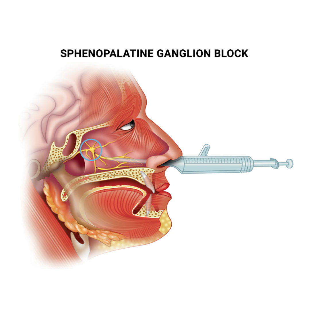 بلوک گانگلیون اسفنو پالاتن sphenopalatine ganglion