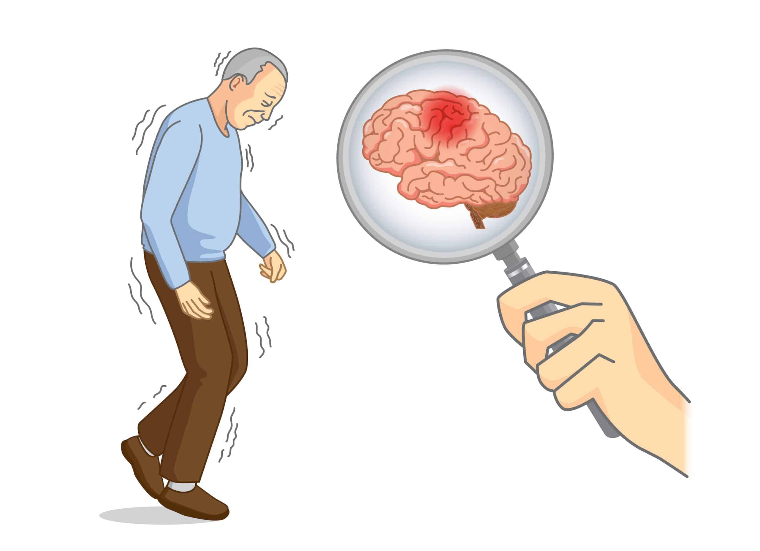 پارکینسون | ام اس